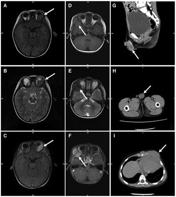 Clinical characteristics, pathology features and outcomes of pediatric myeloid sarcoma: A retrospective case series